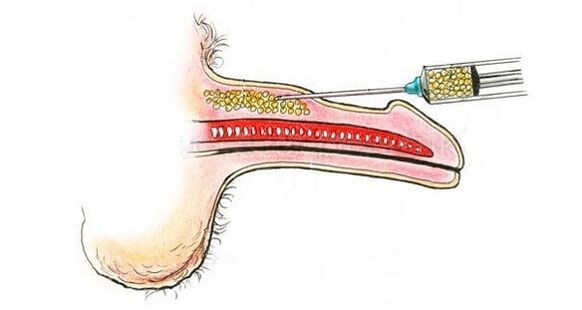 Hyaluronic acid injections in the barrel of a member to increase it